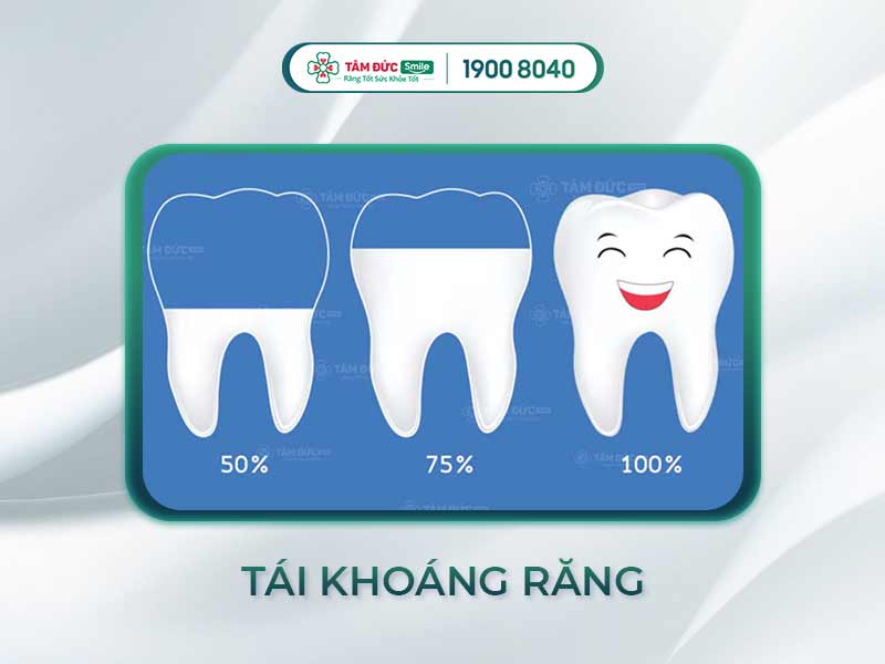 Tái khoáng răng: Phục hồi men răng yếu và ngăn ngừa sâu răng bằng fluoride