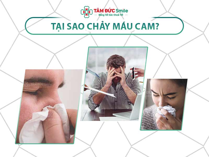 Tại sao bị chảy máu cam? 10 nguyên nhân phổ biến bạn cần biết sớm để phòng ngừa