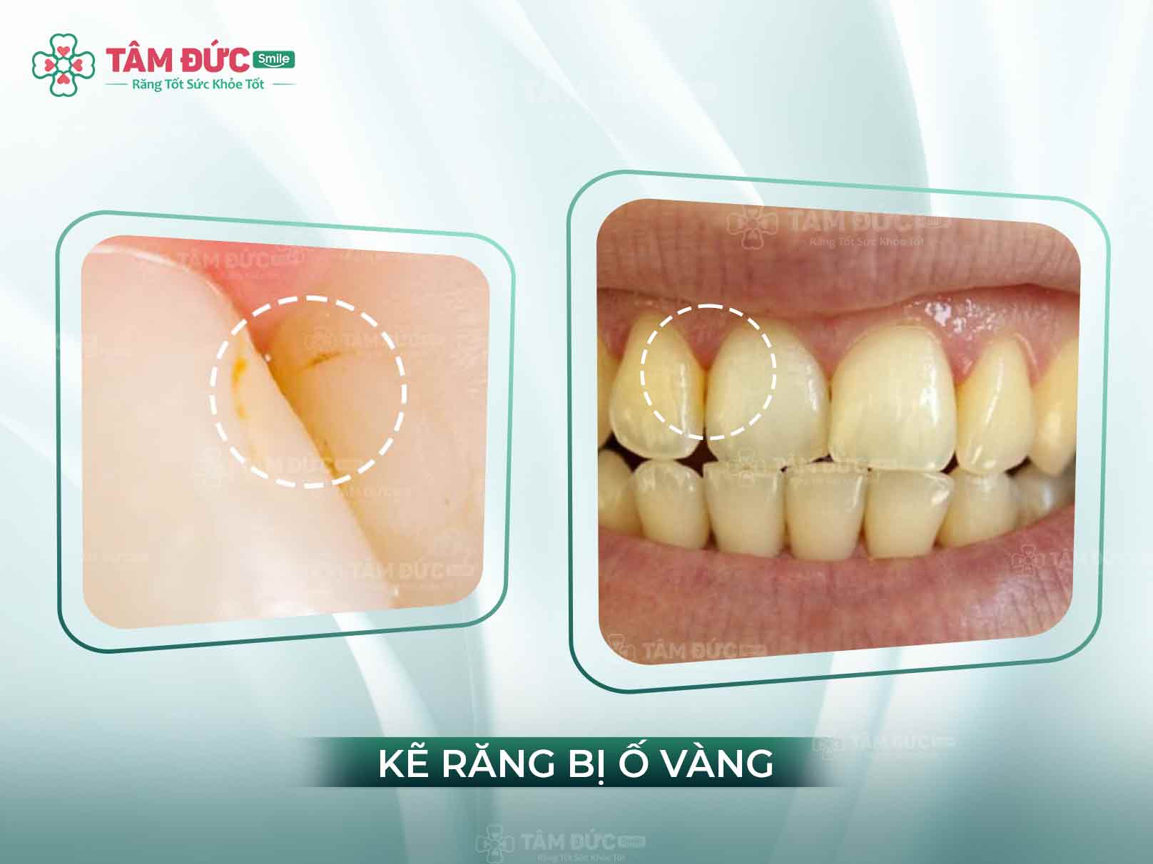 Kẽ răng bị vàng: Nguyên nhân, cách làm sạch và tẩy trắng hiệu quả tại nhà