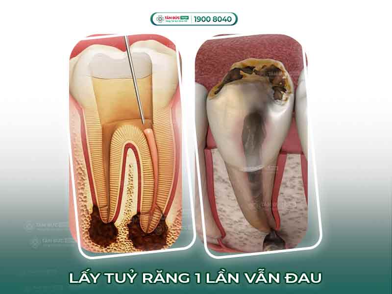 Lấy tủy răng lần 1 vẫn còn đau: Nguyên nhân, dấu hiệu và hướng xử lý
