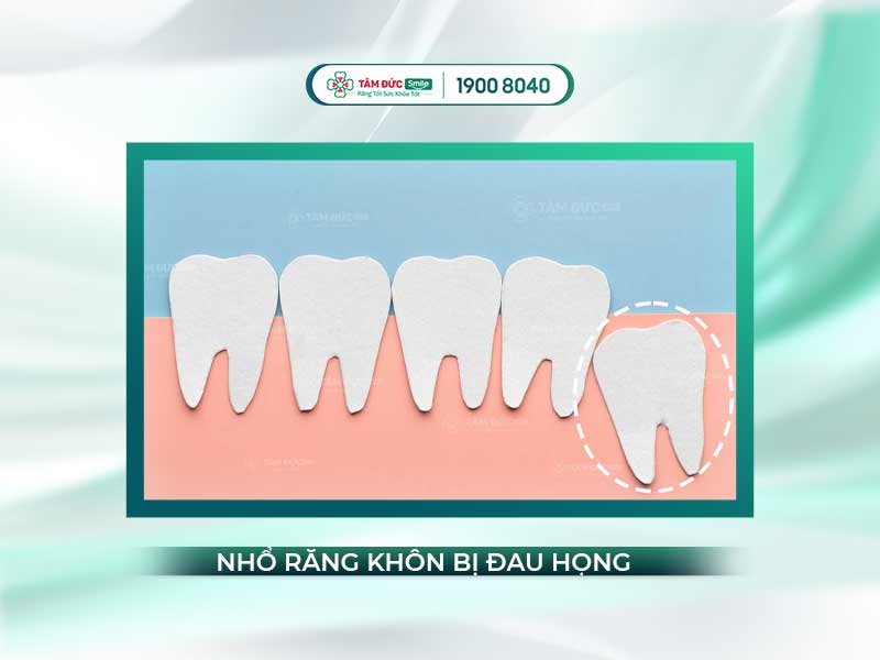 Tại sao nhổ răng khôn bị đau họng? Nguyên nhân, biến chứng và cách xử lý hiệu quả