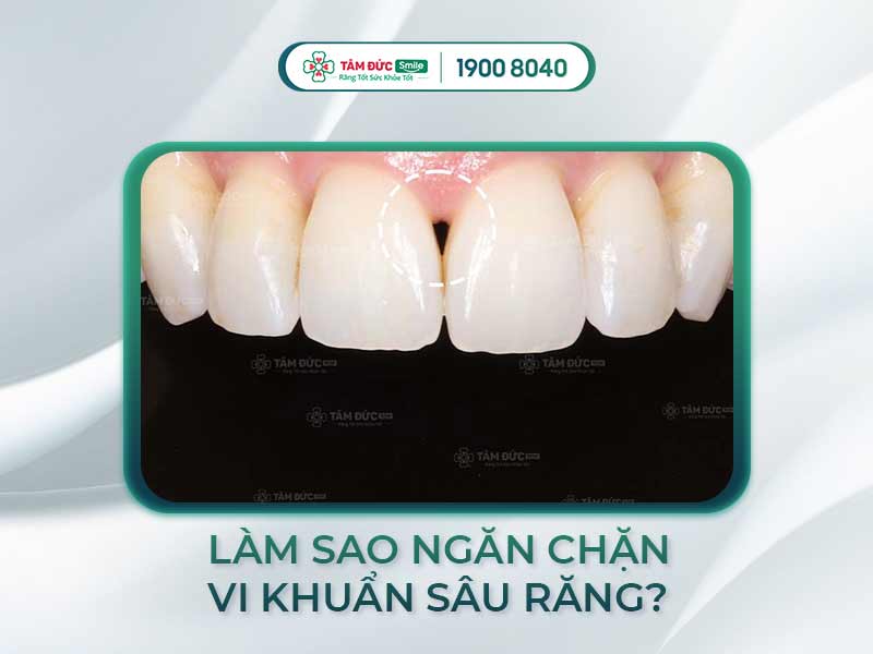 Tam giác đen ở răng: Nguyên nhân, cách điều trị thẩm mỹ hiệu quả tại Tâm Đức Smile