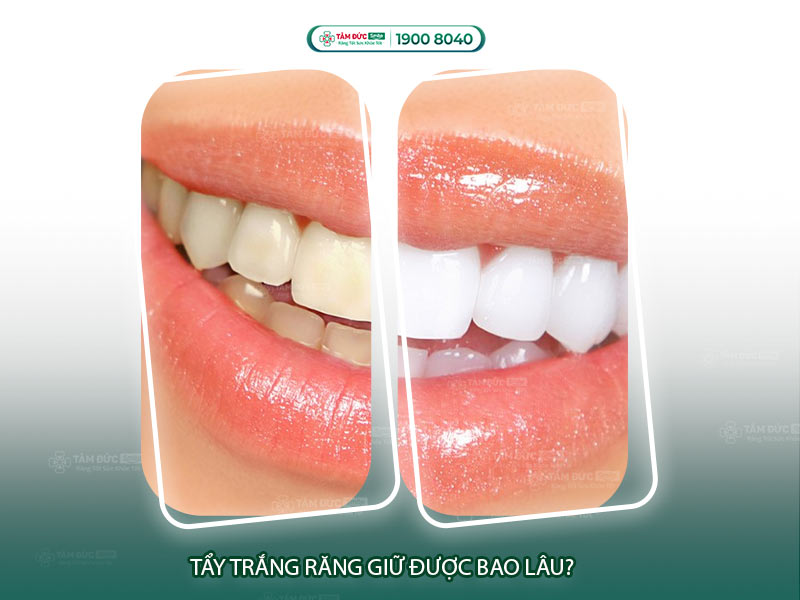 Tẩy trắng răng giữ được bao lâu? Bền màu đến 3 năm tại Nha khoa Tâm Đức Smile
