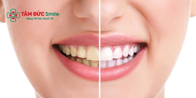 Tẩy trắng răng an toàn không ê buốt tại Nha khoa Tâm Đức Smile - Hiệu quả 3-5 năm