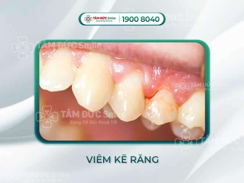 Viêm kẽ răng, đau kẽ răng khi ăn, chảy máu nướu – Cảnh báo viêm nha chu sớm