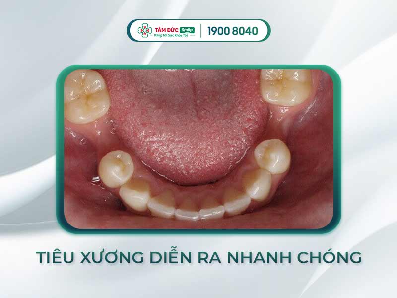 Tiêu xương răng: Nguyên nhân, biểu hiện và cách điều trị hiệu quả bằng Implant