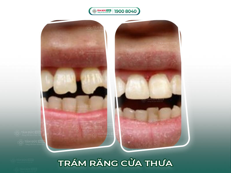 Trám răng cửa thưa bằng composite: Giải pháp thẩm mỹ nhanh, không đau