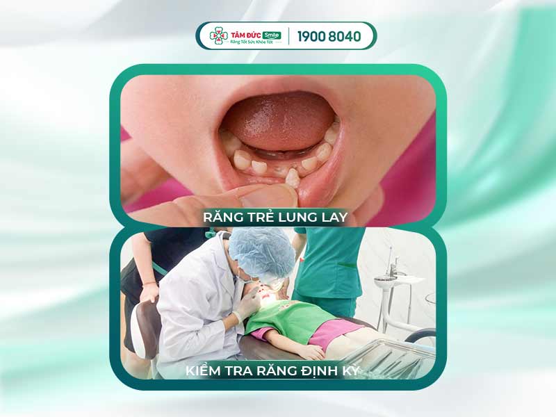 Răng sữa lung lay bao lâu thì nhổ? Dấu hiệu & thời điểm hợp lý cho bé
