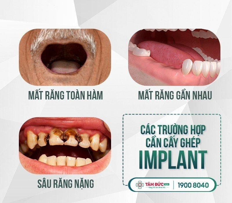 trồng răng sứ có đau không