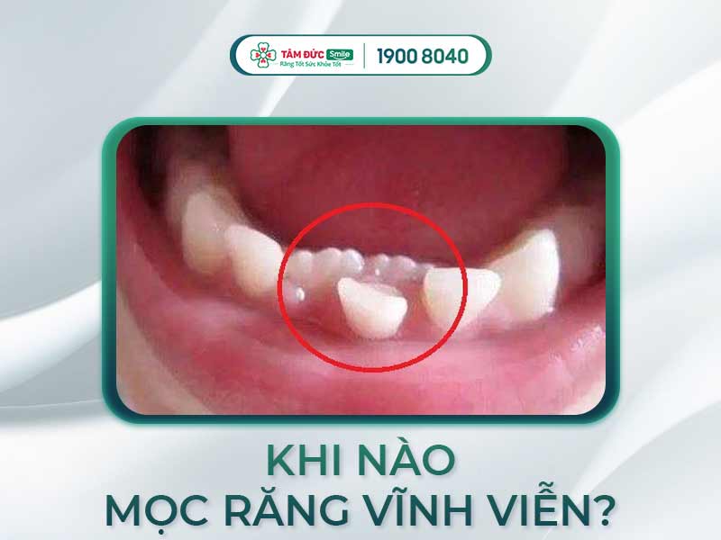 Thời gian và trình tự mọc Răng vĩnh viễn ở trẻ: Cha mẹ cần lưu ý điều gì?