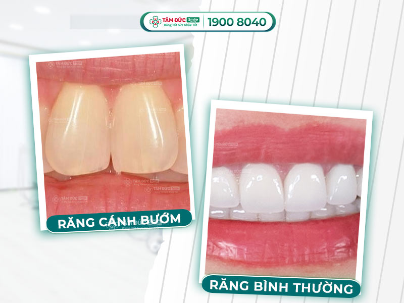 Răng cánh bướm là gì? Dáng răng cửa to, nhô nhẹ có nên chỉnh sửa không?