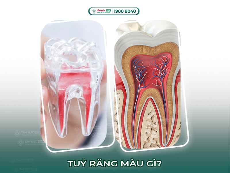 Tủy răng màu gì? Phân biệt màu tủy răng khỏe mạnh, bị viêm và đã chết