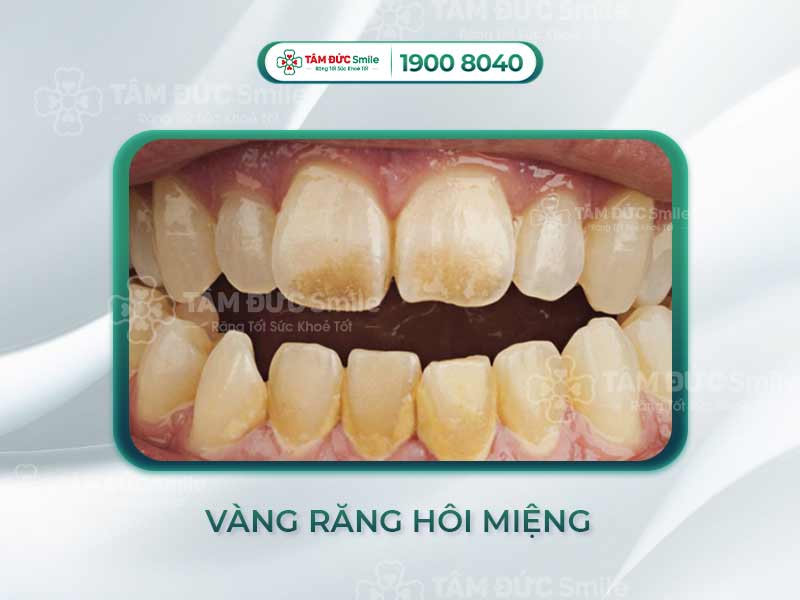 Vàng răng hôi miệng: Nguyên nhân, cách khắc phục tại Nha khoa Tâm Đức Smile