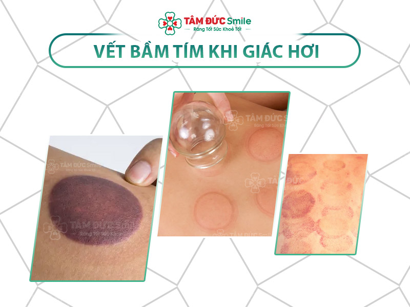 Vết bầm tím khi giác hơi: Nguyên nhân, dấu hiệu, cách chăm sóc và làm tan bầm