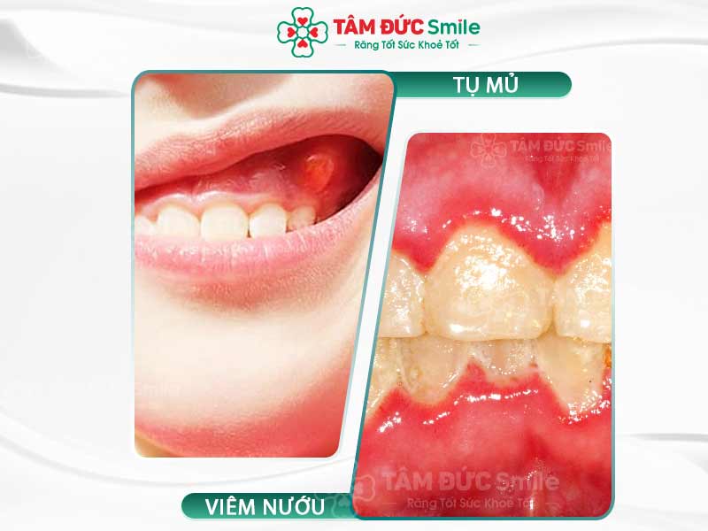 Viêm chân răng có mủ: Triệu chứng, nguyên nhân và cách điều trị hiệu quả