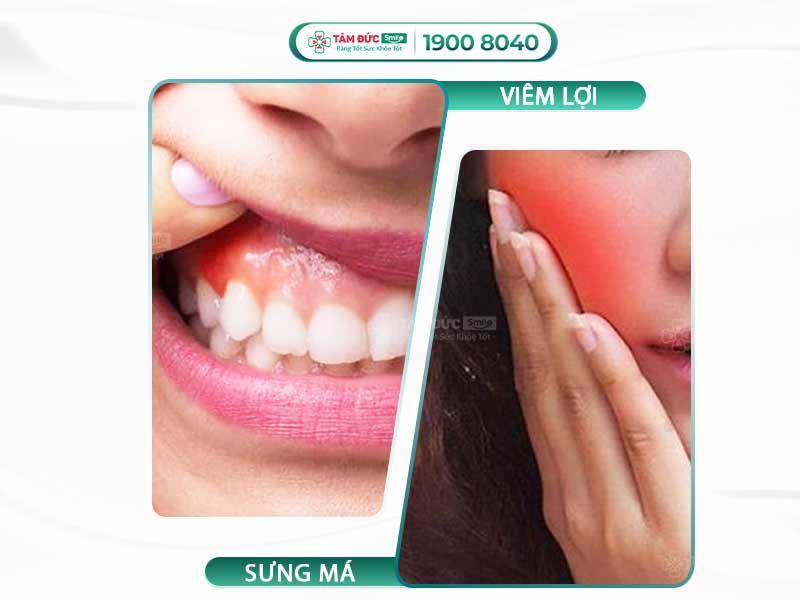 Viêm lợi sưng má: Nguyên nhân, dấu hiệu và cách điều trị hiệu quả nhất