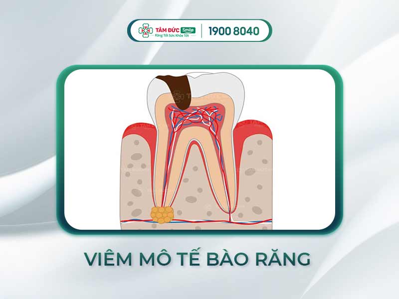 Điều trị viêm mô tế bào răng hiệu quả tại Nha khoa Tâm Đức Smile
