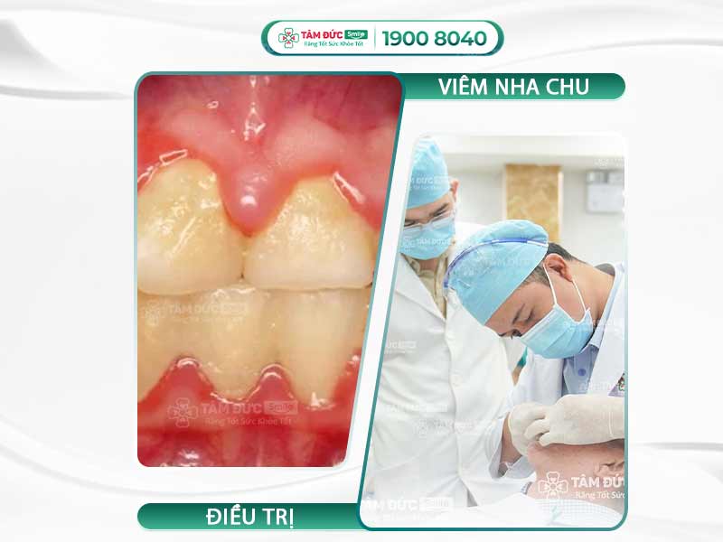 Viêm nha chu: Nguyên nhân, dấu hiệu và cách điều trị