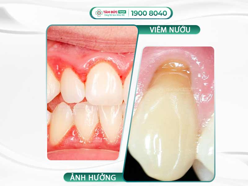Viêm nướu: Nguyên nhân, triệu chứng và cách điều trị tại Nha khoa Tâm Đức Smile