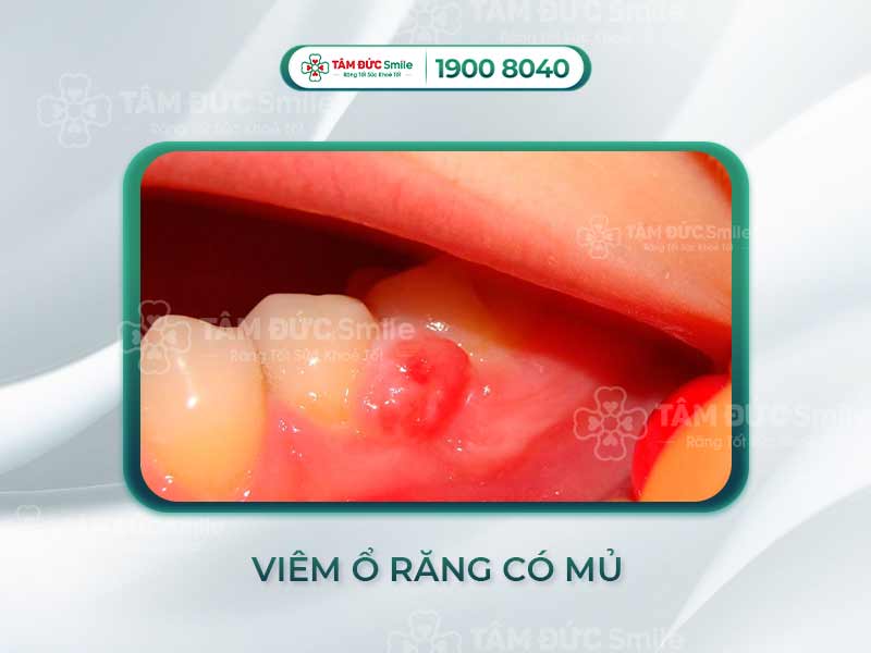 Viêm huyệt ổ răng có mủ: Dấu hiệu, nguyên nhân và cách điều trị hiệu quả nhất