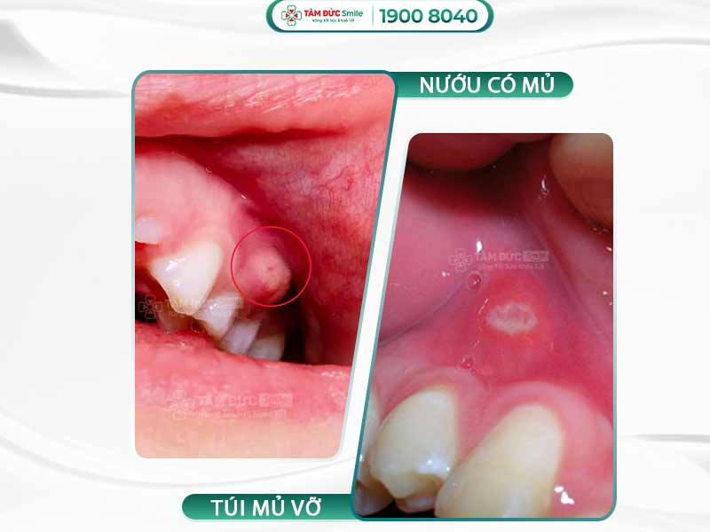 Sưng nướu răng có mủ: Dấu hiệu, nguyên nhân và cách điều trị hiệu quả nhất