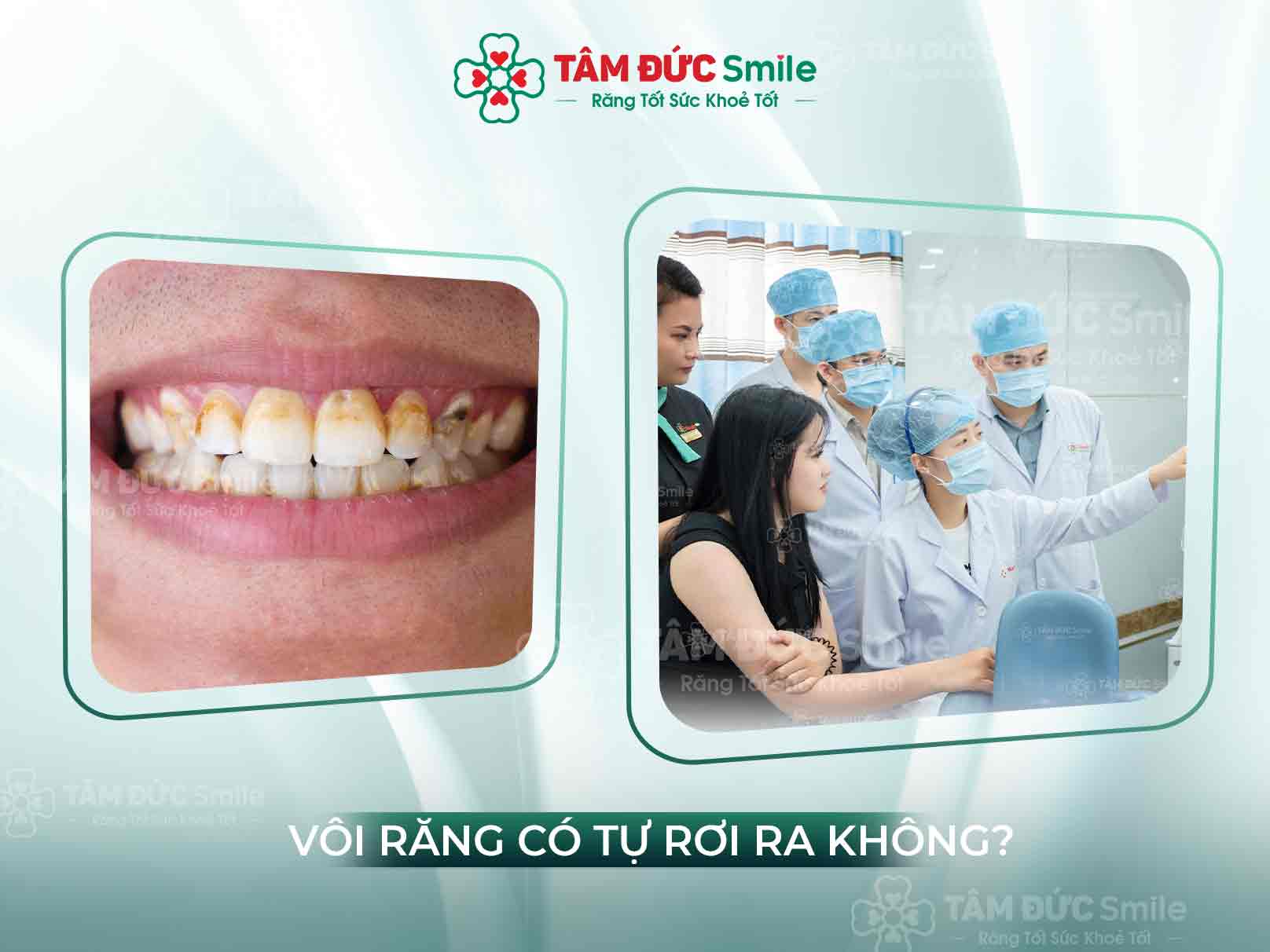 Vôi răng tự tróc được không? Cách xử lý hiệu quả và an toàn tại nhà