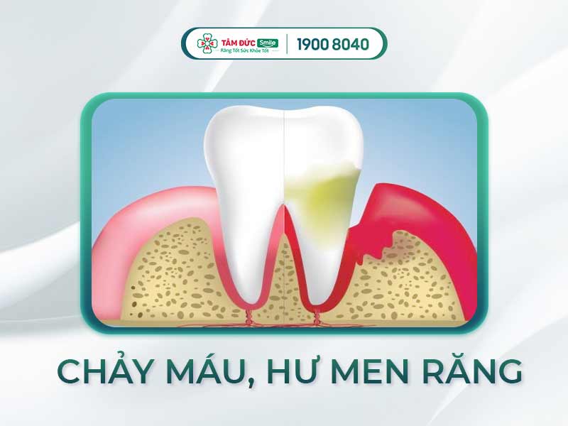 Xỉa răng bị chảy máu: Nguyên nhân, cách xử lý và phòng ngừa hiệu quả tại nhà