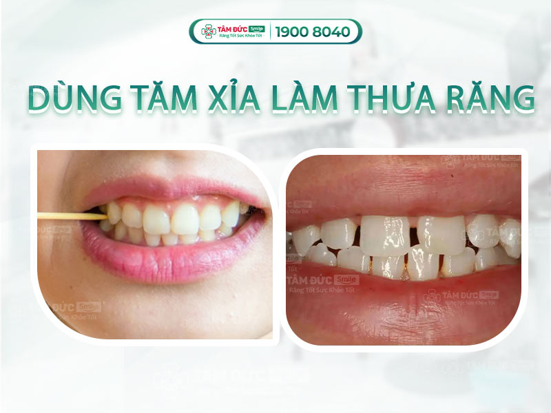 Xỉa răng bị thưa răng: Nguyên nhân, hệ quả và cách khắc phục an toàn hiệu quả
