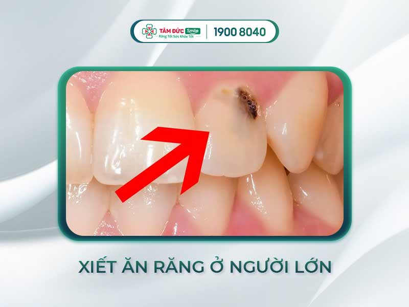 Xiết ăn răng là gì? Quy trình, cảm giác và tần suất xiết trong chỉnh nha