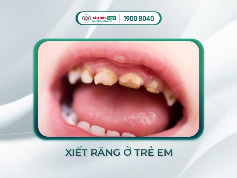 Xiết ăn răng ở trẻ em: Giải pháp chỉnh nha sớm cho răng lệch lạc, khớp cắn sai