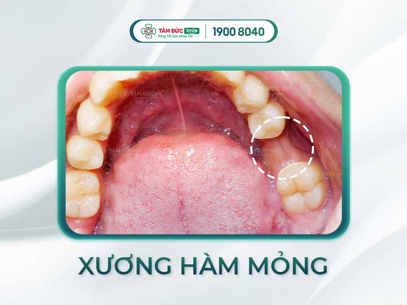 Xương hàm mỏng: Nguyên nhân, ảnh hưởng và giải pháp phục hồi hiệu quả hiện nay