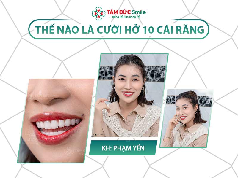 Cười hở 10 cái răng có đẹp không? Tiêu chuẩn nụ cười chuẩn sao